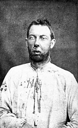 Black and white photograph of Jim Younger after being captured, September 1876. His face and shirt are bloody from a bullet wound in his jaw he received during the shoot out outside Madelia. Photographed by Jacoby’s Art Gallery.